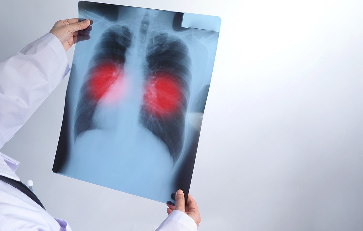 Paraíba registra mais de 1.580 casos de tuberculose em 2025